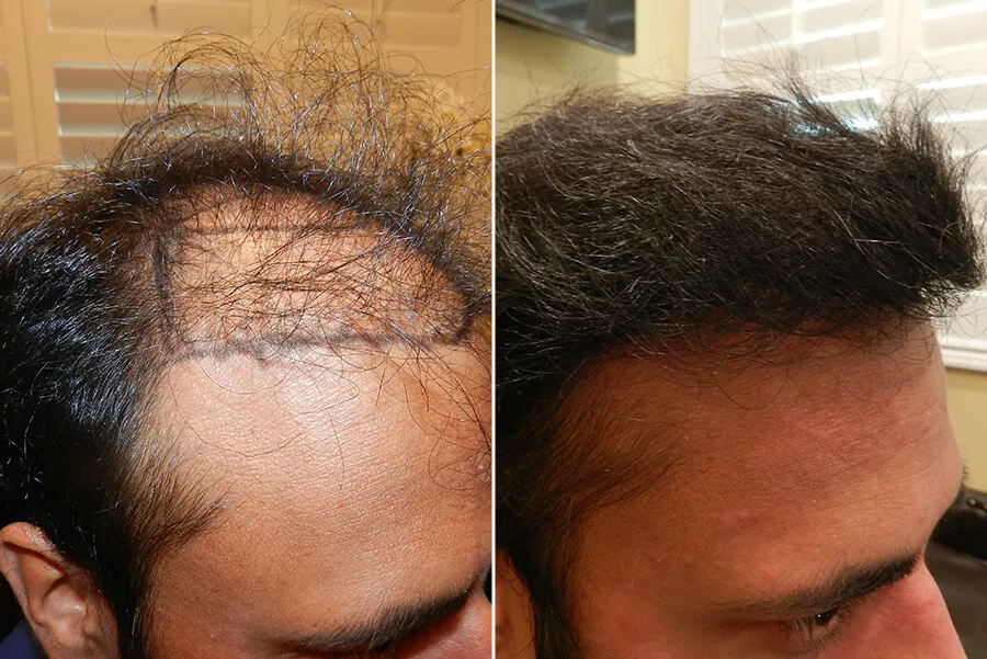 advanced-hair-loss-new-5