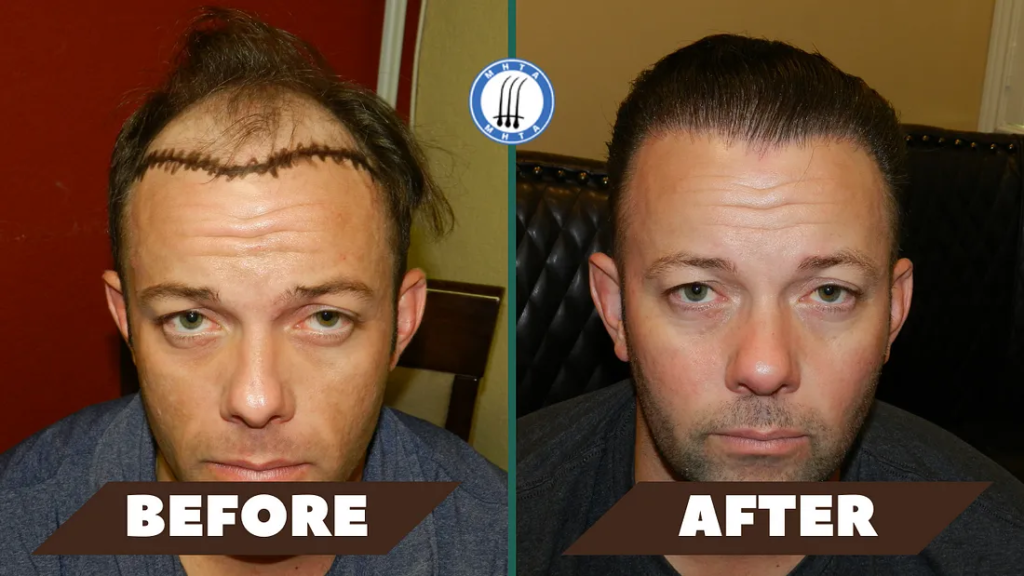 Best Hair Transplant