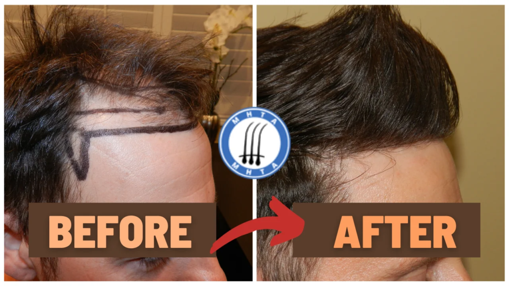 Dr. Diep Review: Life-Changing Hairline Transformations