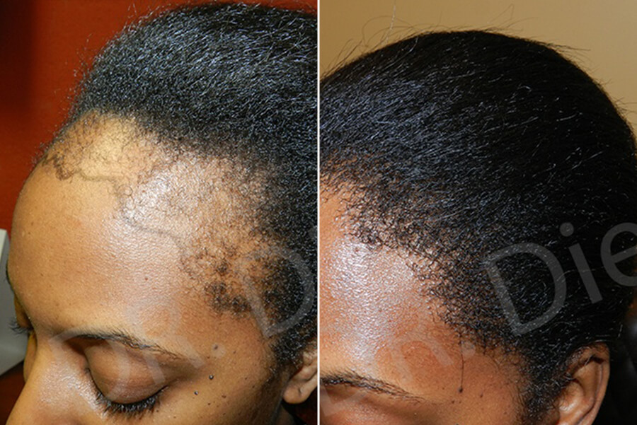 African American Hair Transplants in Texas