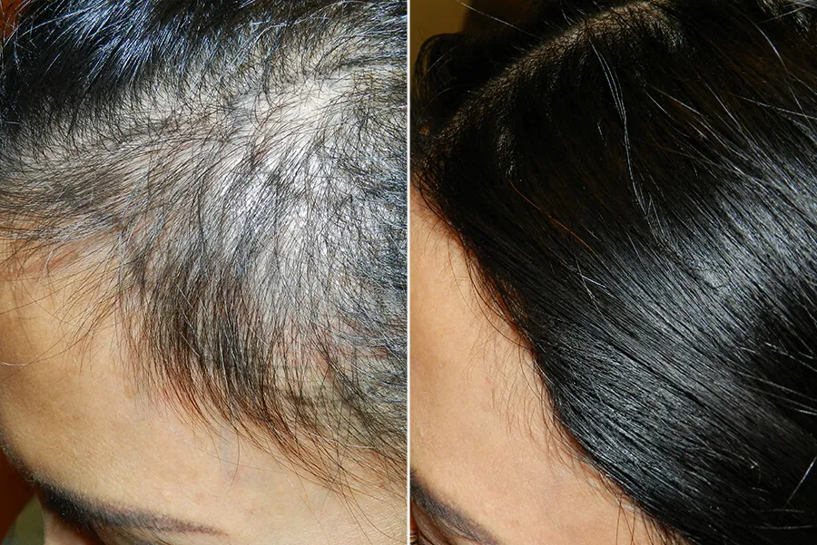 womens-hair-transplant-new-9-1