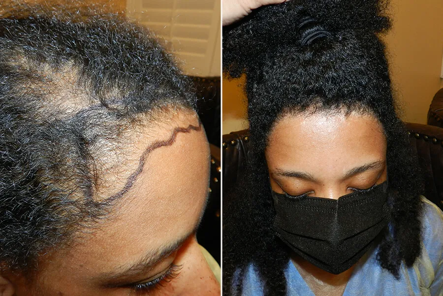 womens-hair-transplant-new