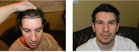 FUE hair transplant in San Francisco